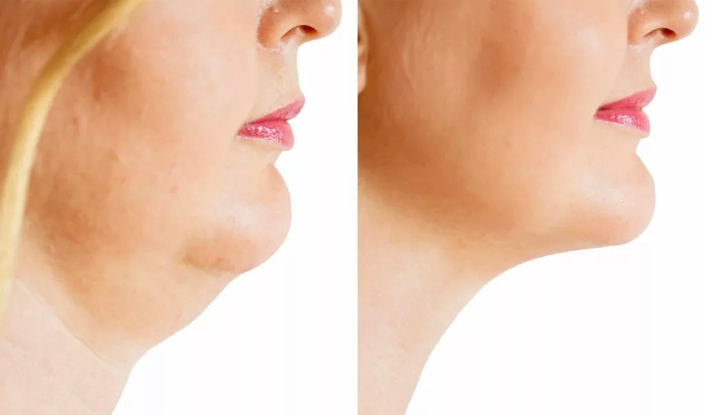 Face, Chin and Body Fat Dissolving Treatment