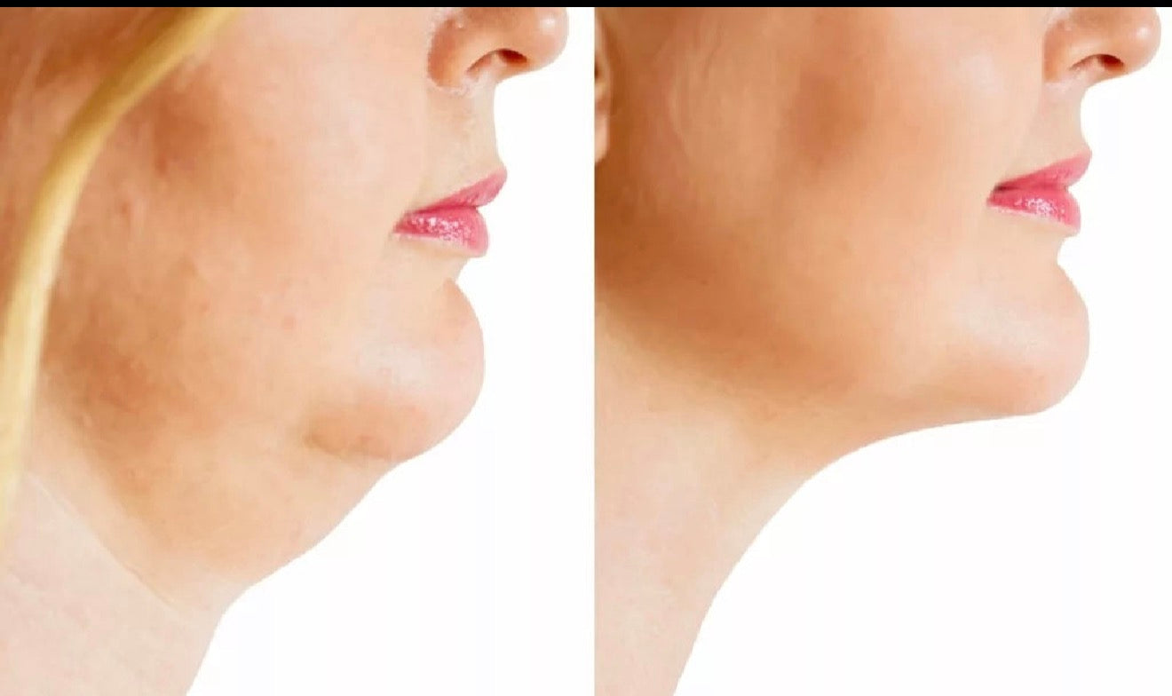 Face, Chin and Body Fat Dissolving Treatment